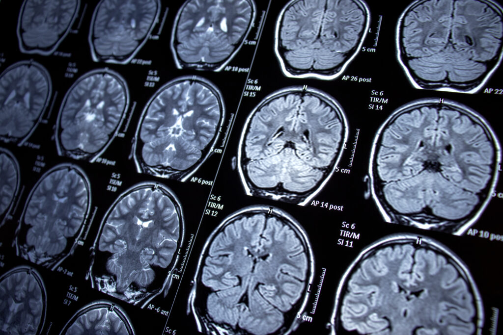 traumatic brain injury scan